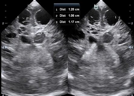 pegogram|Radiopaedia.org